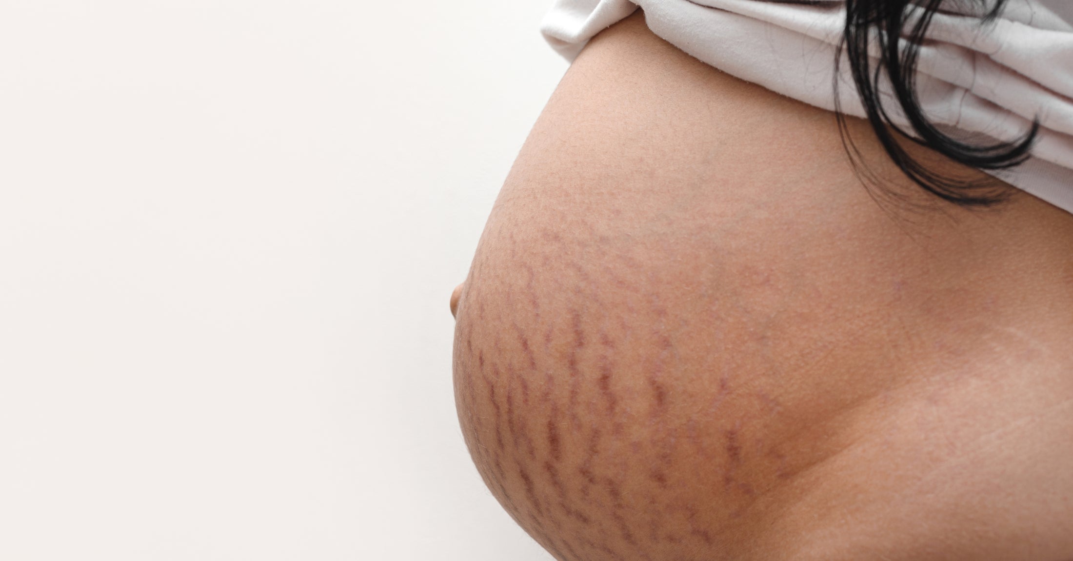 Schwangerschaftsstreifen: So kannst du ihnen vorbeugen